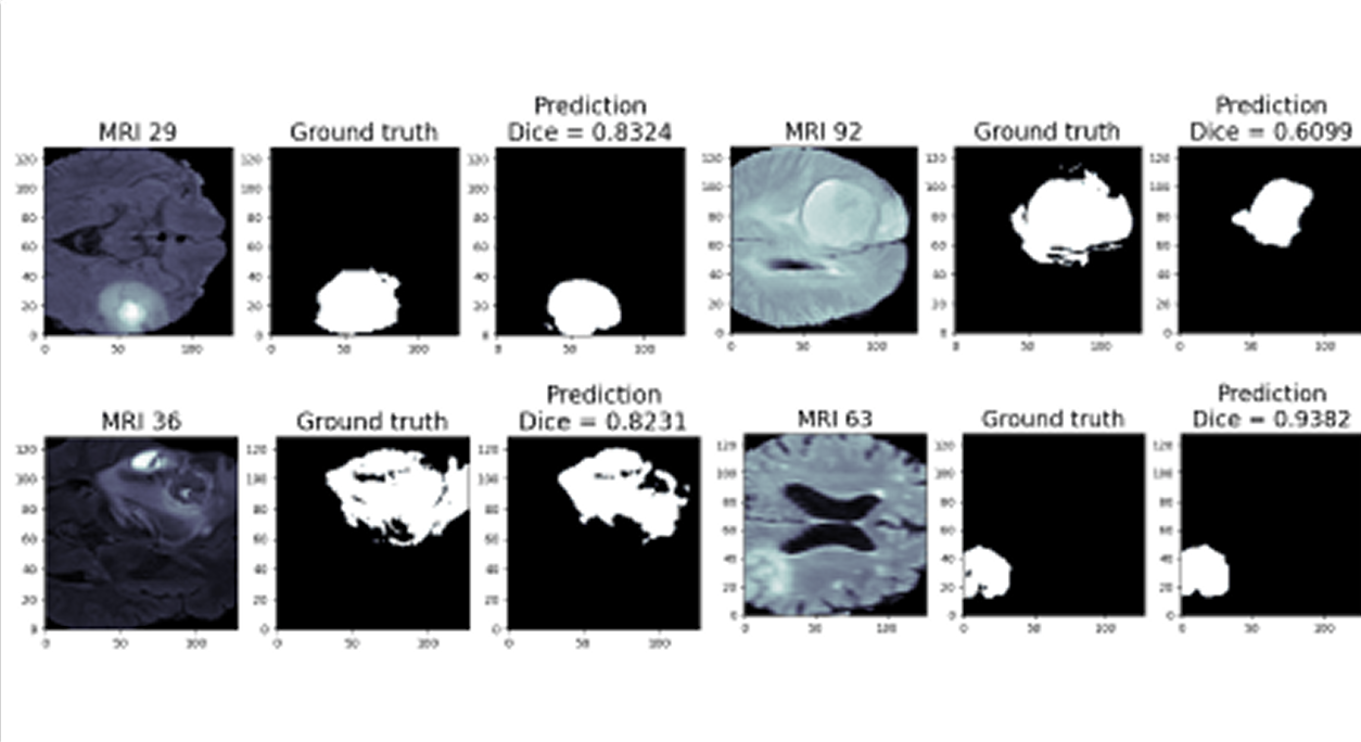 Brain Tumor Detection