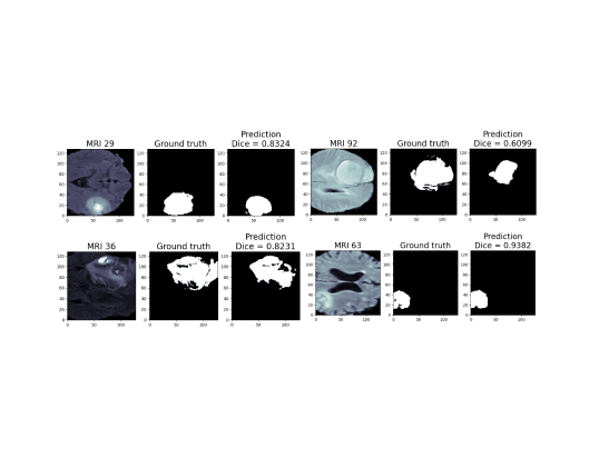 Brain Tumor Detection Using MRI Segmentation